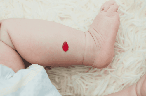 Trẻ xuất hiện u máu 15 tháng chưa hết có phải dị dạng mạch máu không?