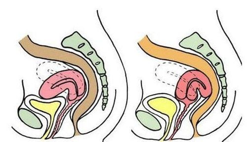 4. Ảnh hưởng của tử cung ngả trước đến khả năng sinh sản