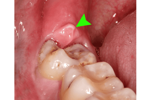 Bị lợi trùm có phải nhổ răng khôn?