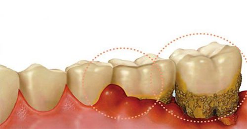 
Tình trạng viêm khiến lợi sưng đỏ phì đại và chân răng bị lỏng lẻo
