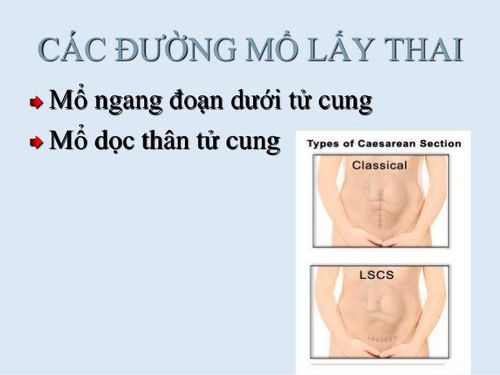 
Vỡ tử cung trong thai kỳ có thể xảy ra ở thai phụ có sẹo mổ cũ do mổ lấy thai ở thân tử cung
