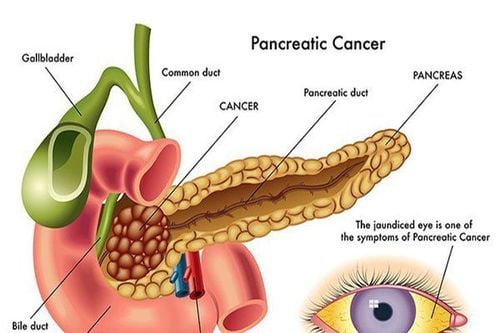 Severe acute pancreatitis: Can fasting help the pancreas to rest?