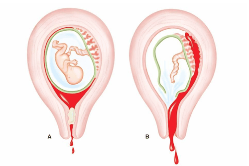 
Sản phụ vỡ tử cung nhanh chóng cấp cứu khẩn cấp
