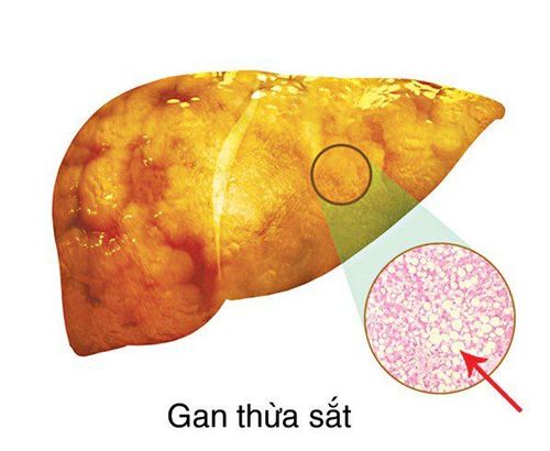 Tác hại nếu cơ thể bị thừa sắt