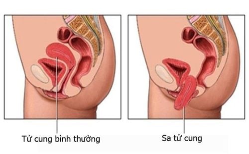 The uterus of someone with the condition differs significantly from that of a healthy person.