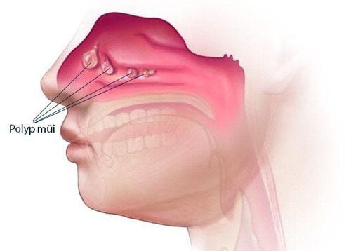 Long-term sinusitis can cause nasal polyps