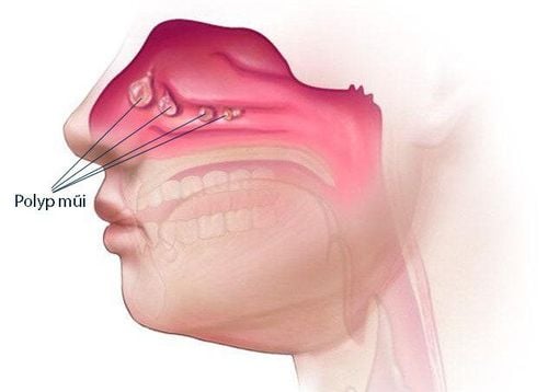 
Nạo sàng xoang mũi được chỉ định khi phẫu thuật đồng thời với cắt polyp mũi
