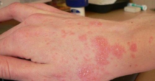 Common fungal skin diseases