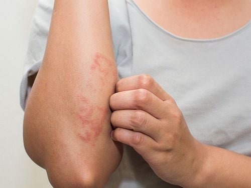 Causes and warning symptoms of contact dermatitis