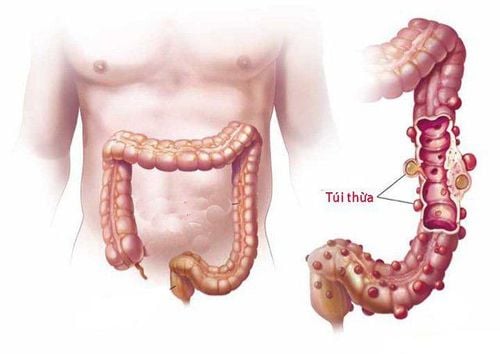 Warning signs of diverticulitis