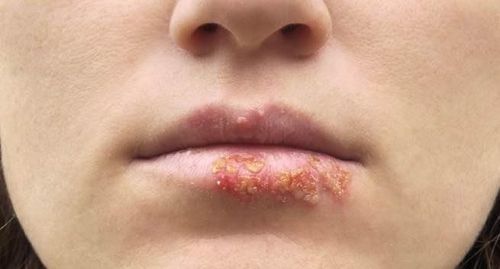 
Với người lớn bị bệnh zona do virus Herpes Zoster và mụn rộp quanh miệng, valacyclovir cũng được dùng để điều trị những đợt bùng phát mụn rộp ở cơ quan sinh dục
