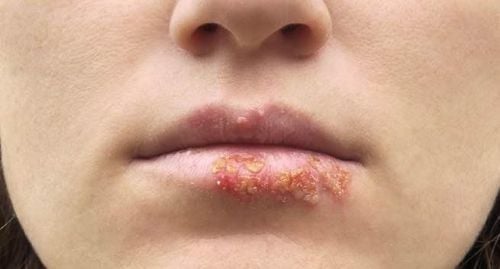 Virus nào gây mụn rộp ở miệng?