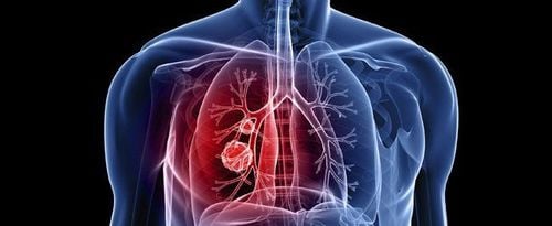 What is pulmonary hypertension?