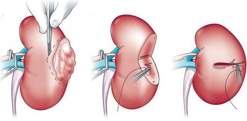 In which cases is partial nephrectomy indicated?