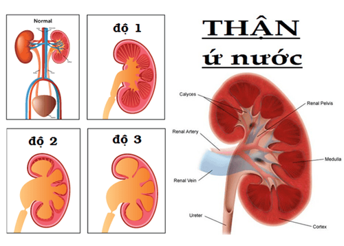 
Thận ứ nước được chỉ định phẫu thuật nội soi cắt chỏm nang thận sau phúc mạc
