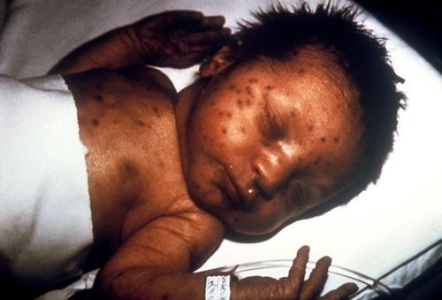 Severe consequences of congenital rubella