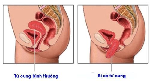 Degrees of genital prolapse in postpartum women