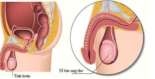 
Hầu hết ung thư tinh hoàn phát triển trong các tế bào có chức năng sản xuất tinh trùng
