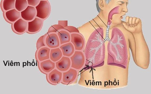 Tests to help diagnose pneumonia