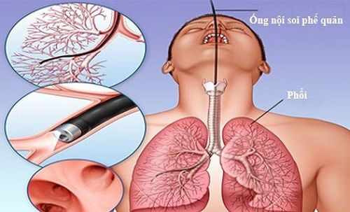 Purpose of bronchoalveolar lavage, alveolar lavage