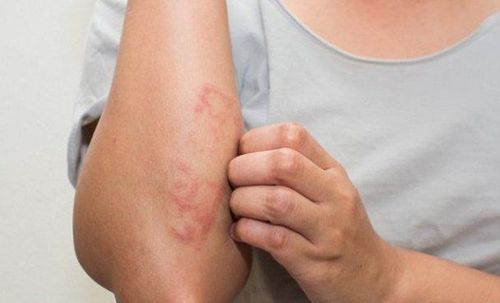 How to deal with chronic, recurrent atopic dermatitis?