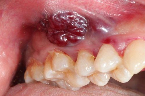 Blood tumors in the oral cavity