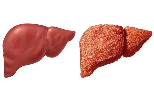 Possible progression of acute hepatitis B