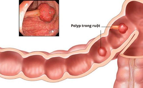 
Một số loại polyp đại tràng ở trẻ em thường gặp
