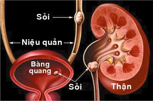 
Nội soi tán sỏi ngoài cơ thể
