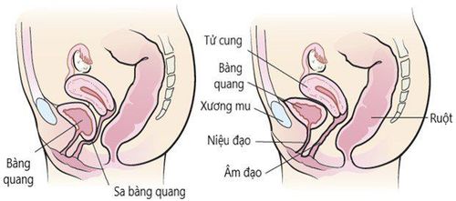 Treatment of bladder prolapse