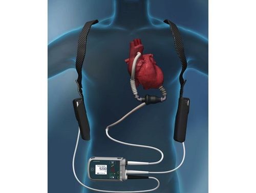 
Thiết bị bơm HeartMate II là một máy bơm nhỏ hoạt động như động cơ phản lực
