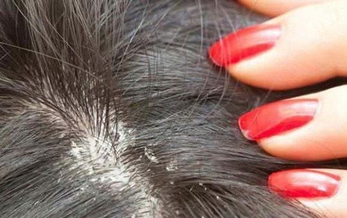 What to Do When You Have Scalp Fungus?