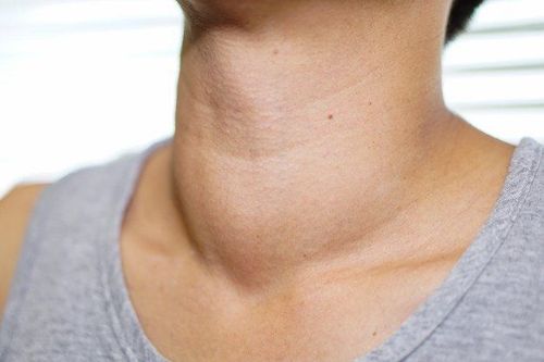 Autoimmune Hyperthyroidism: What you need to know