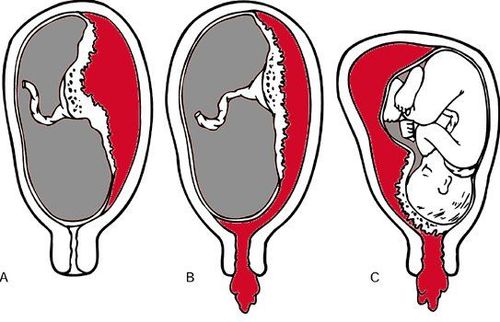 
Quá nhiều nước ối làm tăng nguy cơ bong nhau thai (bong nhau sớm)
