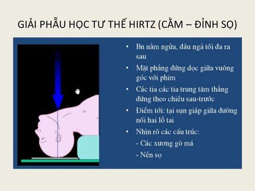 
Tư thế Hirtz
