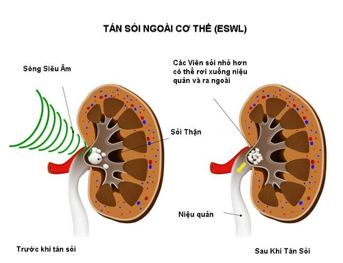 
Kỹ thuật tán sỏi ngoài cơ thể
