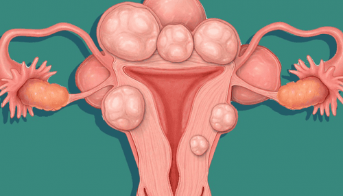 Sau mổ nội soi bóc u xơ tử cung thường hay bị đau quặn bụng và đau lưng khi đến kỳ kinh nguyệt có đáng lo không?