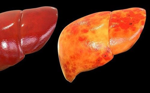 Non-alcoholic fatty liver: Diagnosis and treatment