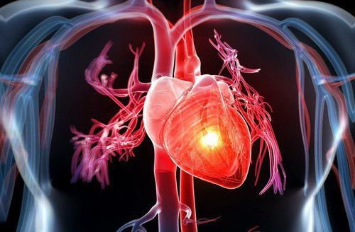 Can thiệp động mạch vành qua da: Những điều cần biết