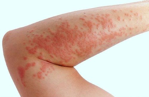 
Sẩn mề đay là triệu chứng ban đầu của bệnh bọng nước Pemphigoid
