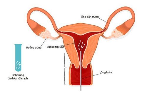 
Nguy cơ biến chứng khi thực hiện IUI rất thấp
