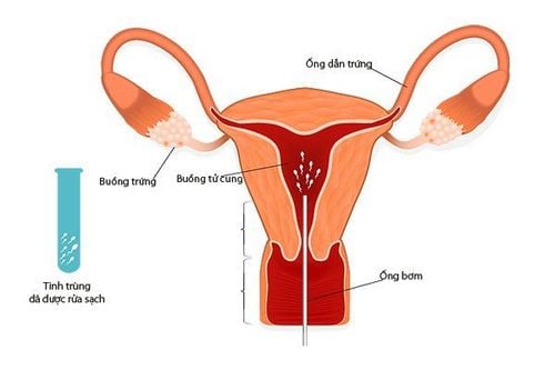 Những Câu Hỏi Thường Gặp Về IUI