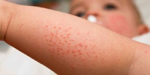 Typhus in children: Signs to see a doctor