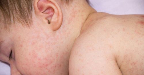 Children with typhus fever, what to do?