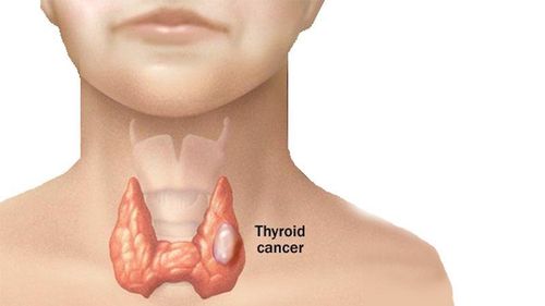 Can hyperthyroidism be cured? When to have surgery?