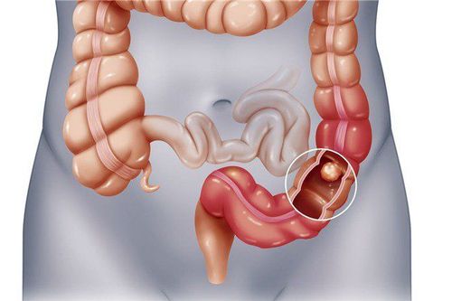 Laparoscopic right and left colectomy in the treatment of rectal cancer