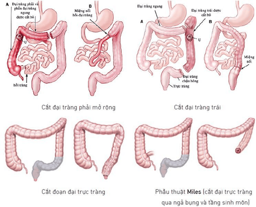 
Cắt đại trực tràng là cách điều trị ung thư đại trực tràng hiệu quả
