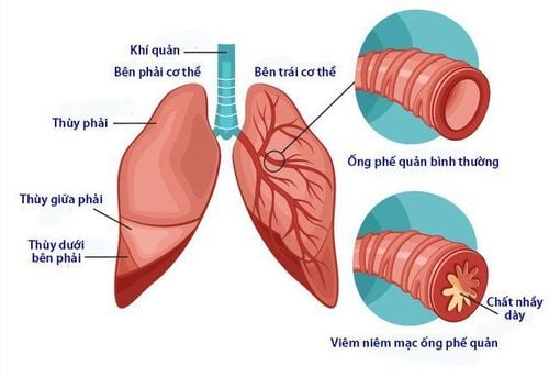 
Bệnh viêm phế quản biểu hiện bằng tình trạng viêm lớp niêm mạc ống phế quản
