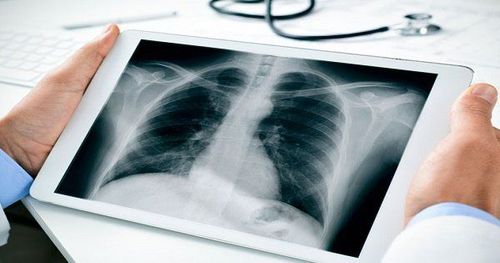 Chụp X quang phổi tư thế đỉnh phổi ưỡn giúp phát hiện tổn thương vùng đỉnh phổi