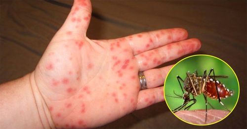 Bệnh nhân sốt xuất huyết có thể bị những đốm chảy máu, xuất huyết trên da